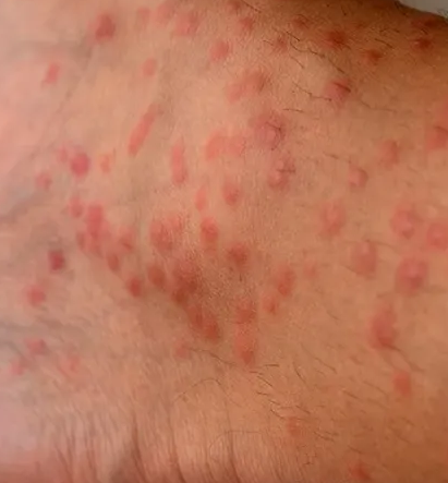 How Do You Stop Eczema from Spreading?