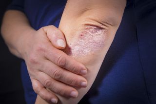 Different types of Psoriasis