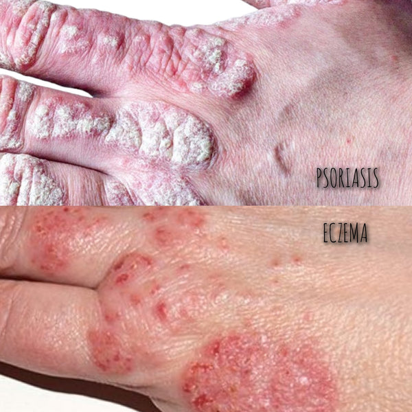 How do I Know if it’s Eczema or Psoriasis?