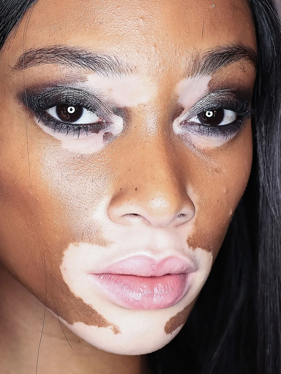 Is Vitiligo a Disease?