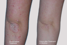 Load image into Gallery viewer, Dermahealer Psoriasis Elbow Treatment Results